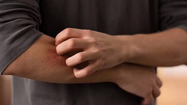 Aumento dei casi di dermatofilosi in Europa: Pregliasco rassicura sul basso rischio, ma avverte sui cambiamenti nelle modalità di trasmissione